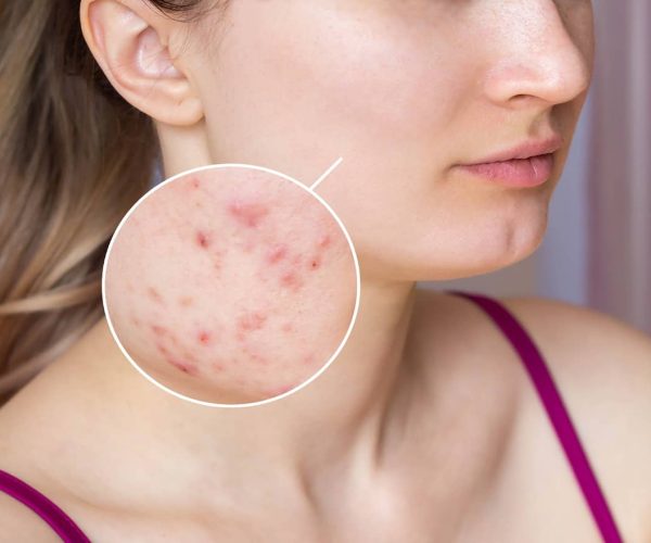 cropped-shot-of-young-womans-face-with-acne-skin-in-zoom-circle-pimples-red-scars-rash-on-cheeks